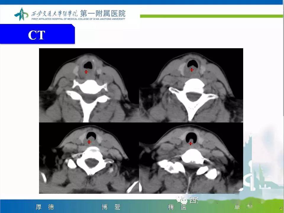 精彩病例气管腺样囊性癌