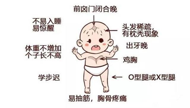 一岁宝宝佝偻病症状图片
