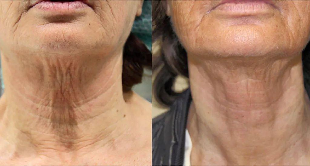 火鸡脖.3【下面部】因软组织下垂而导致的松垂.