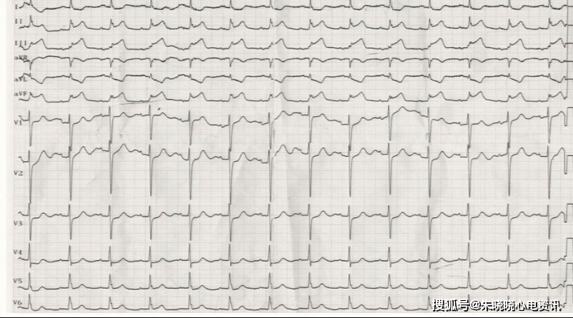 急性心梗心電圖再思考