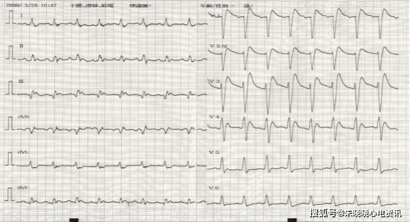 急性心梗心電圖再思考