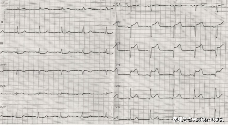 心包积液st段弓背向下图片