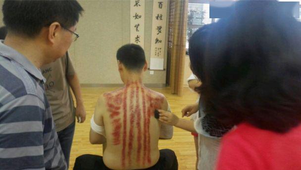 患者无痛顺利出痧2.