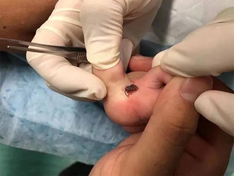 警惕13岁男童被虫咬生命垂危宝宝更易中招已数千人被咬伤