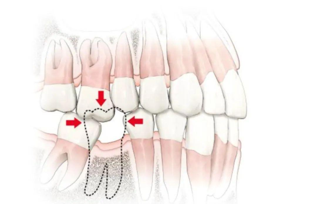 甚至造成无法修复缺齿,而且可能不得不拔除移位或塌下的牙齿