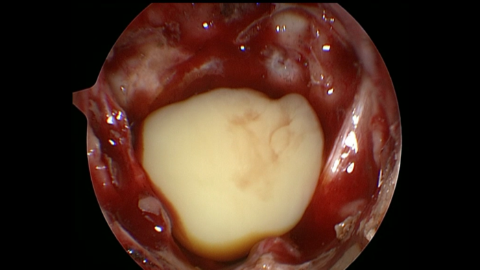 原创近日治愈一位少见的垂体脓肿患者