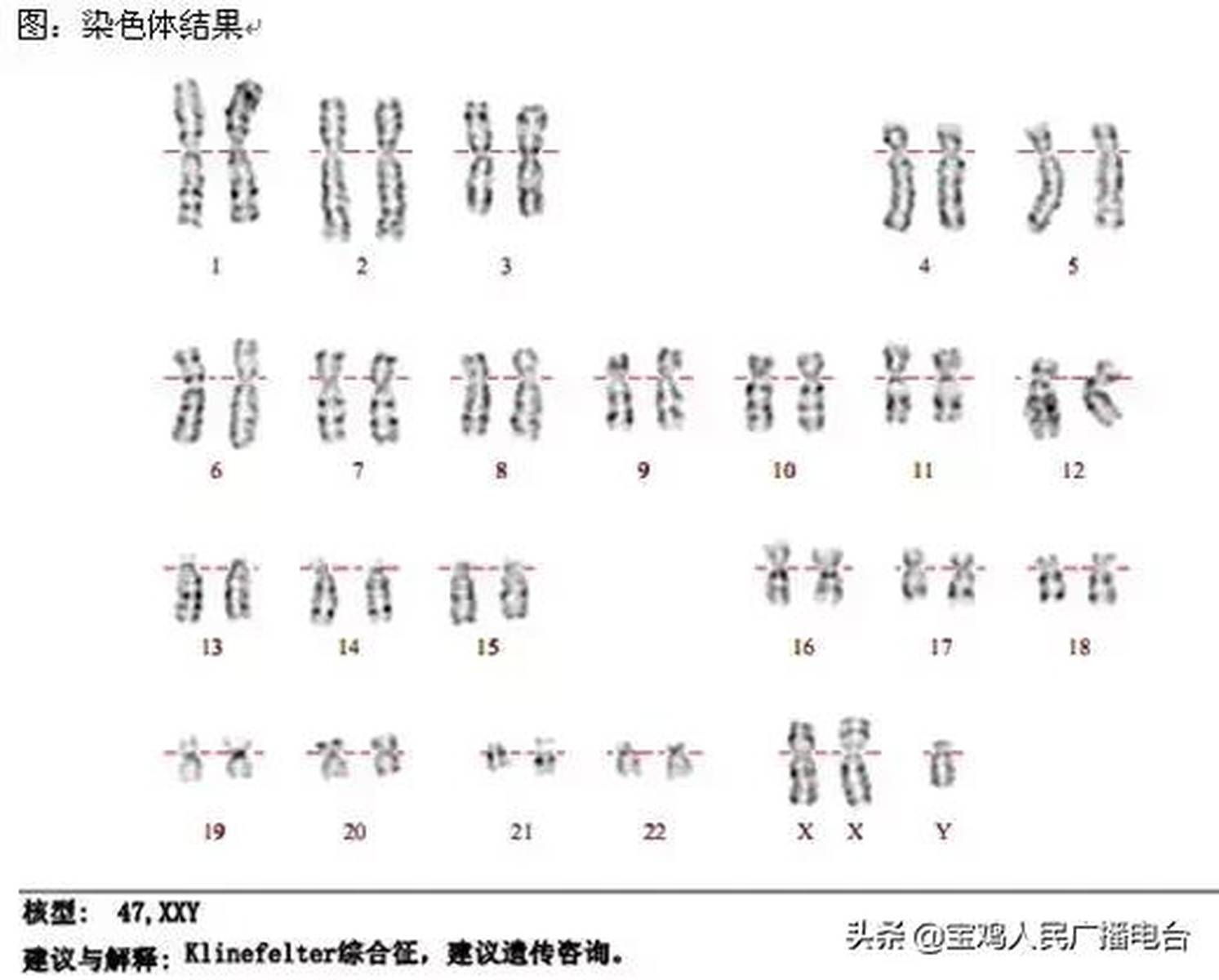 克氏、超雄、超雌综合征是什么,详解染色体异常遗传病(2)