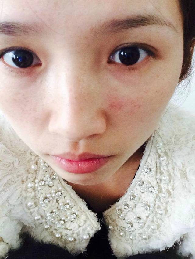 悠悠告诉你,抓住夏季三个月成功淡斑!