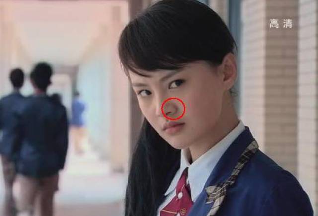 招黑,取出假体后居然变得比以前更美了,鼻梁变挺鼻翼缩小,看起来灰常