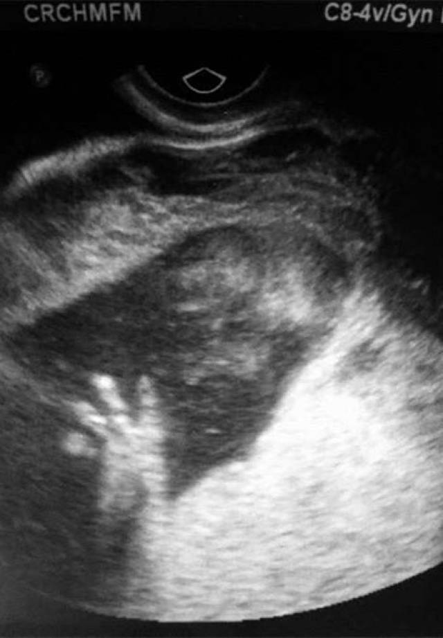 6个月打掉胎儿图片图片
