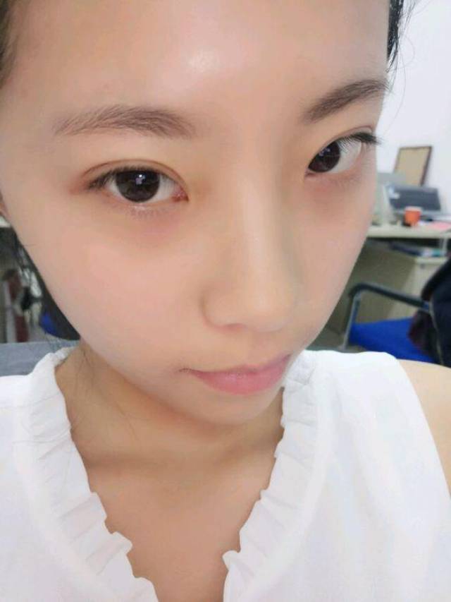 感觉眼睛一上一下的,都说我的眼睛斜着长的 有没有修复的方法 微信