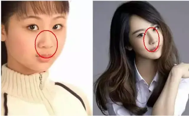 鼻孔微微向上且鼻翼外扩,缩小之后鼻