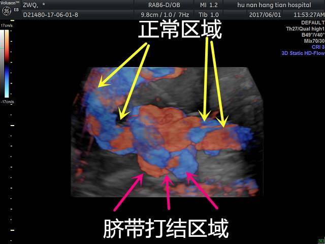 (超声检查:脐带打结区域)