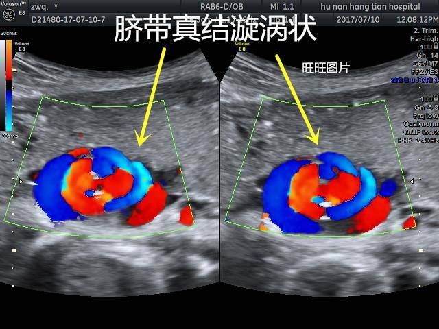 助产士怀二孩脐带打结!却坚持上班,结果宝宝?