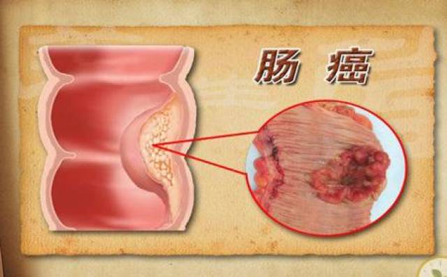 哪种大便凹槽是肠癌图片