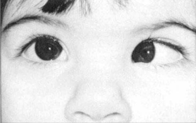 看东西眼睛有点"斜",孩子可能患了这类病!