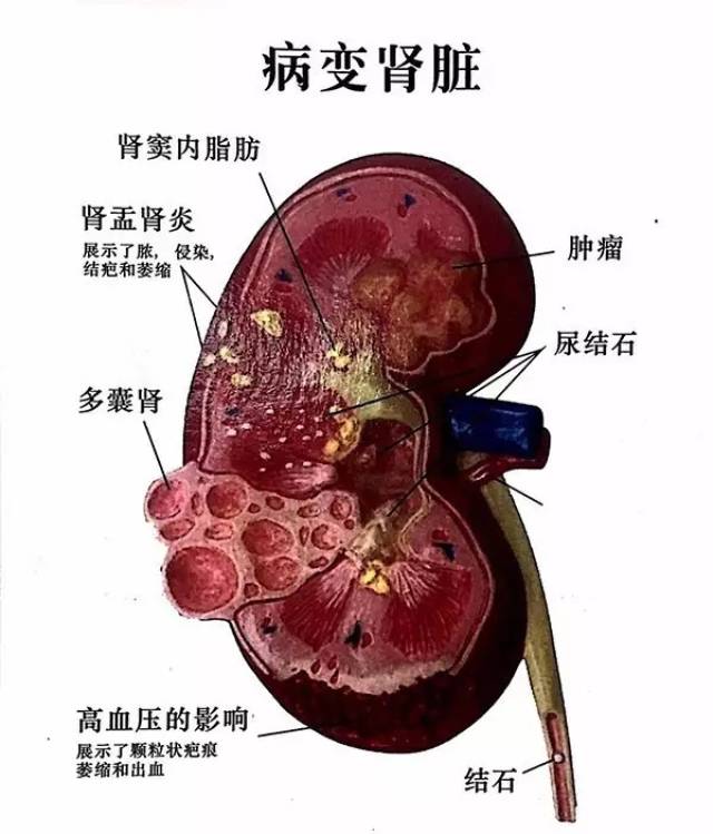 解析b超双肾结石患者的6次成绩单