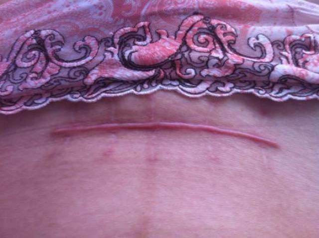 剖腹产后疤痕正常图片图片