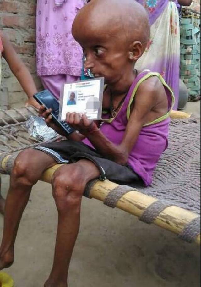 21岁男子有160岁身体,比正常人衰老快8倍,震撼