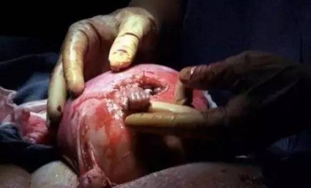 的小男孩,这个其时只有6个月大的胎儿轻轻捉住了大夫做动手术的大手