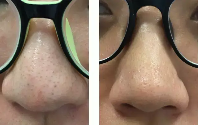 10种痘痘类型分析,教你对症下药祛痘