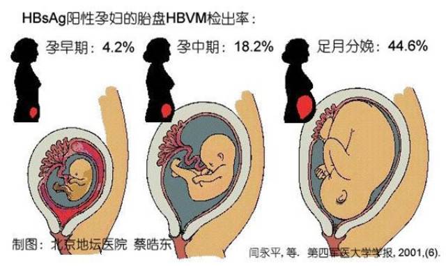 乙肝孕婦不同孕期胎盤中乙肝病毒的檢出率