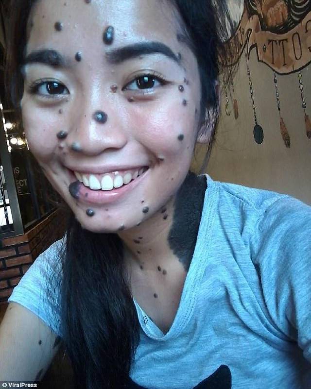 20岁女子全身长满黑痣,如今可能成为环球小姐