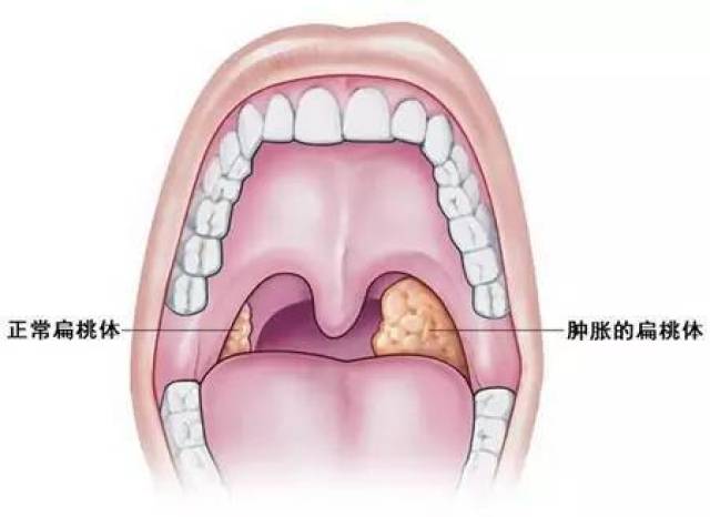 咳出黄色小颗粒你的喉咙发生了什么