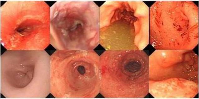 一种植物杀死幽门螺旋杆菌,修复胃粘膜