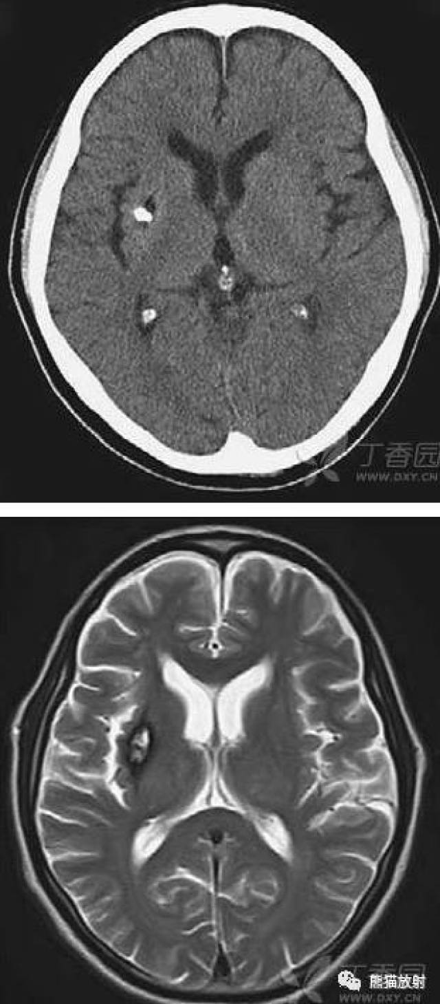 脑海绵状血管瘤10mm图片