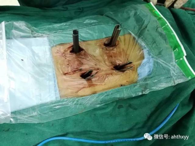 腰椎手术钢钉图片图片