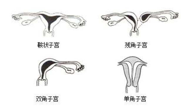 残角子宫分型图片图片