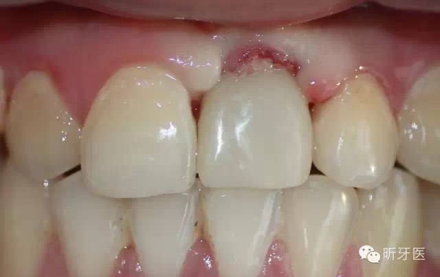 成品基台制作树脂临时冠,螺丝固位,软组织塑形 牙齿戴入即刻,形态颜色