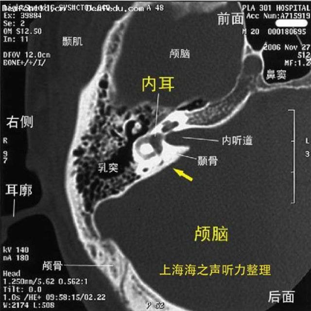 内耳ct解剖结构图图片