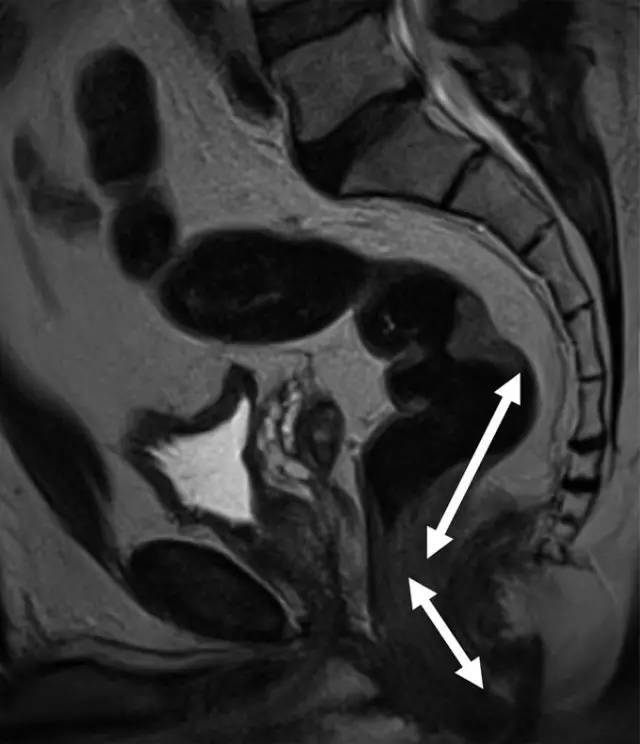 中位直肠癌患者的矢状 t2 加权图像.