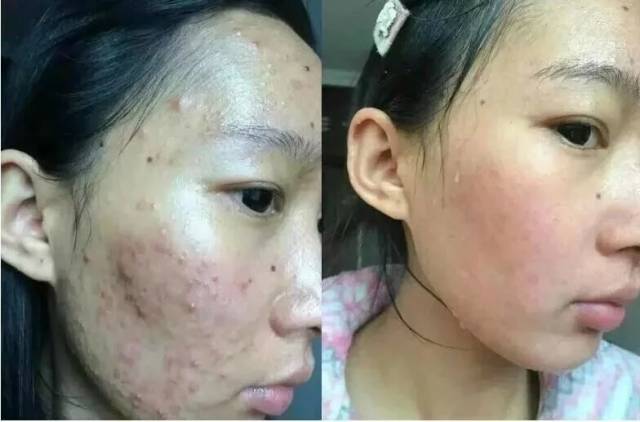 没那么简单,这些排毒祛痘的误区需要纠正!