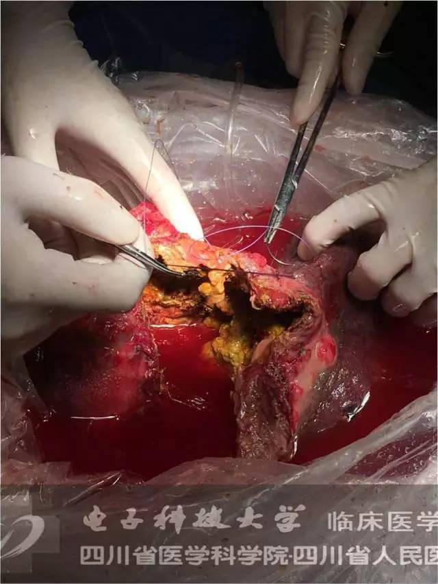 图文并茂:复杂肝包虫离体肝切除 自体肝移植术