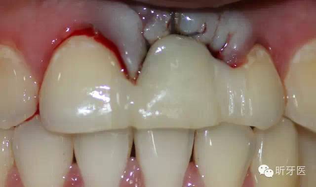 前牙单颗即刻种植及美学修复