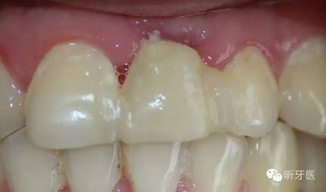 前牙单颗即刻种植及美学修复