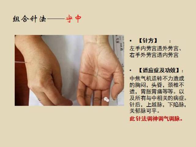 阴阳九针组合针法之守中针法