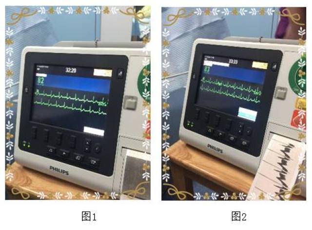 【时讯】祝贺我院成功完成第1例在心电定位下置入中心静脉导管(picc)