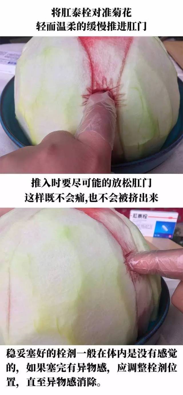 痔疮栓怎么用图片