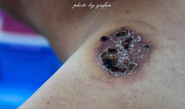 拔罐会留下这样的痕迹,看着挺吓人的