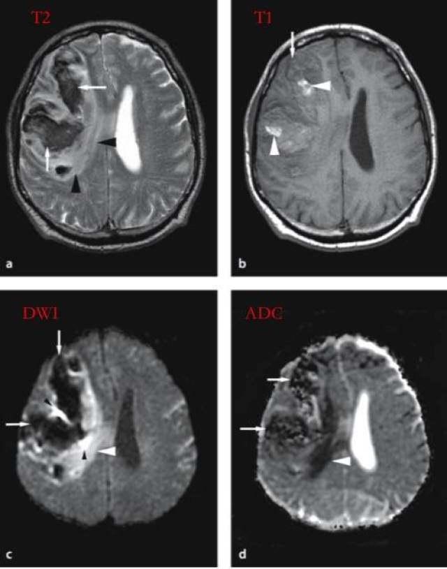 【相关专业】一文理清脑梗死 dwi 表现|临床基础