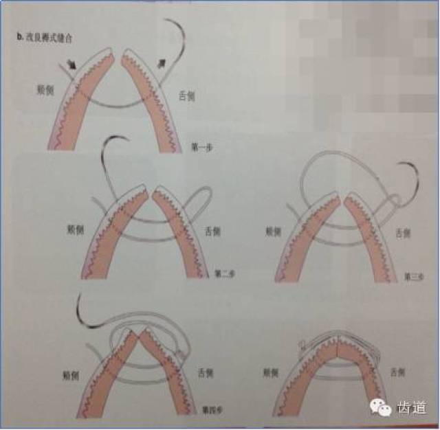 牙周引导组织再生术图片