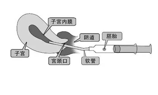 感觉神秘的取卵,移植术其实并不神秘