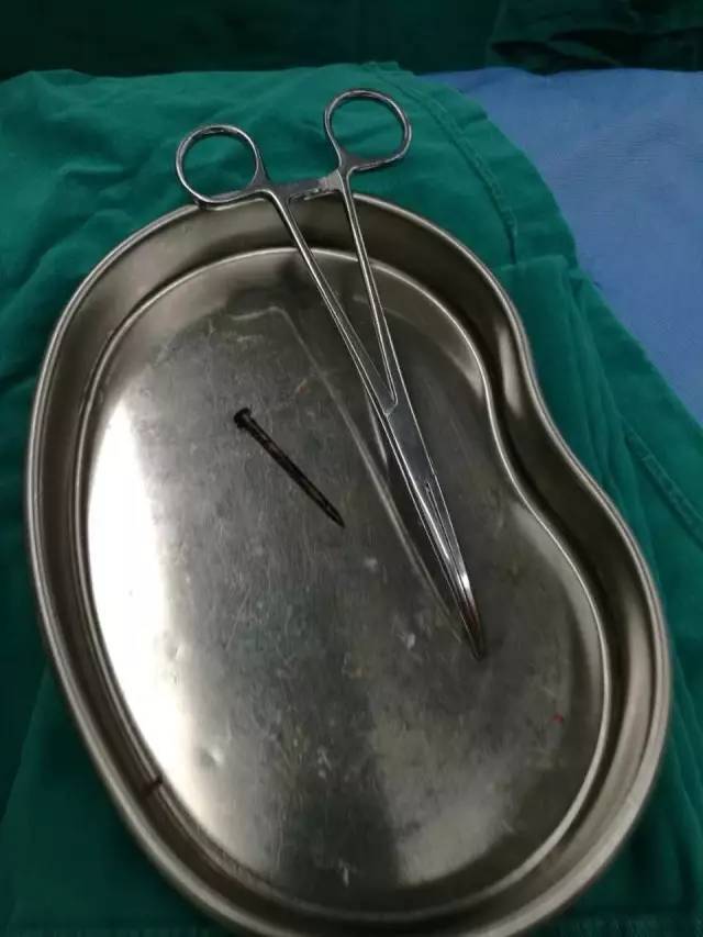 男子大意,钉子竟插入眼睛里!医院为一男子险取"眼中钉"