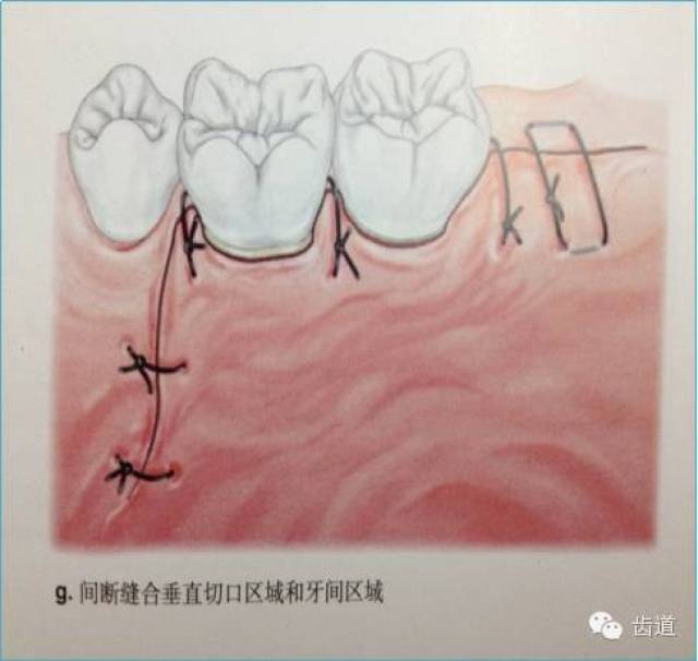 龈瓣切除术图解图片