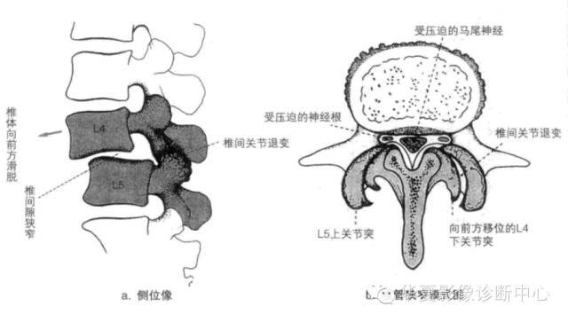 腰椎弓峡部解剖图图片