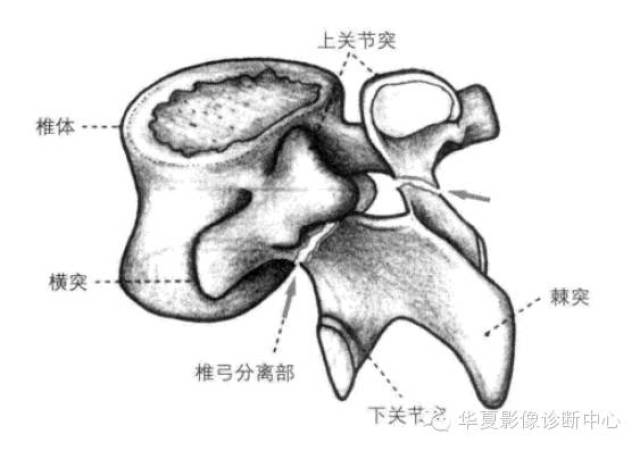 影像解剖基础 腰椎椎弓峡部裂与椎体滑脱